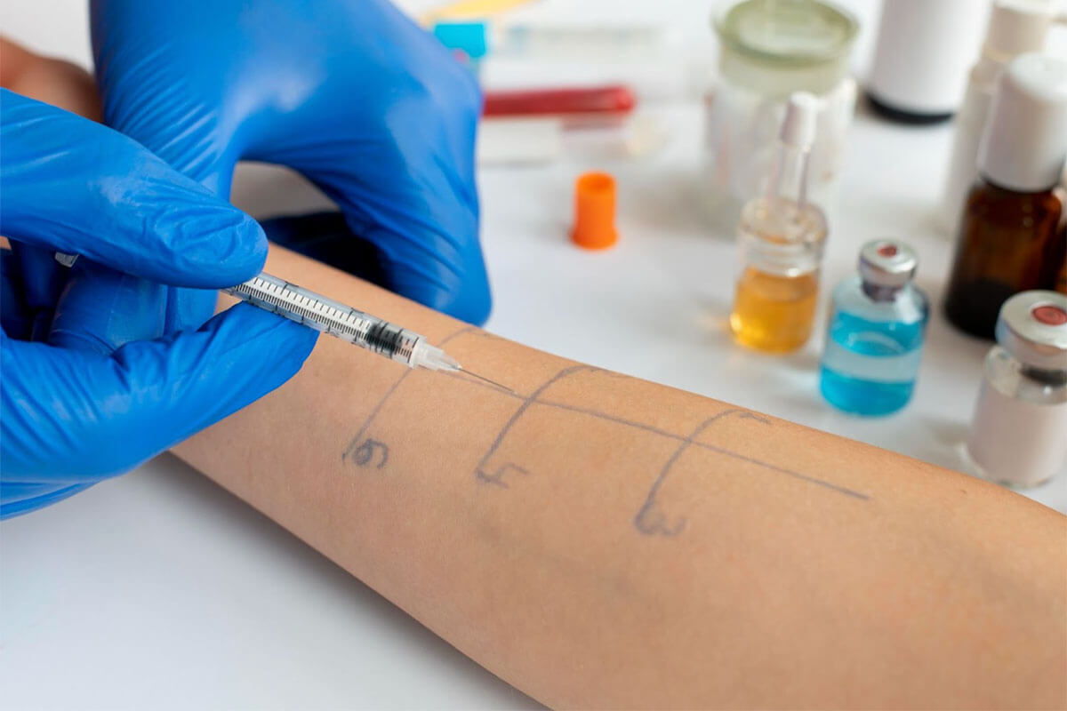 What You Should Know About Allergy Testing